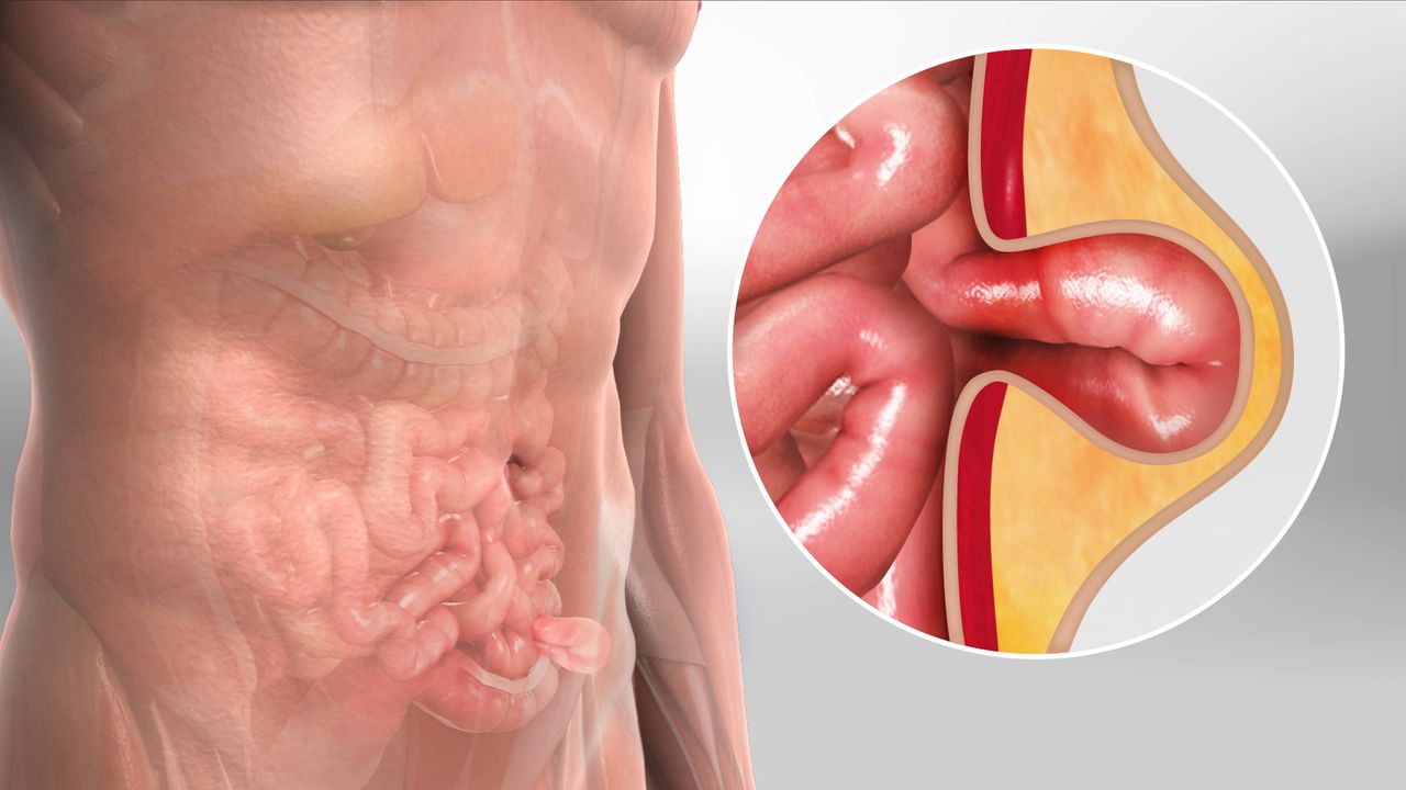 Hernia Specialist in Pune